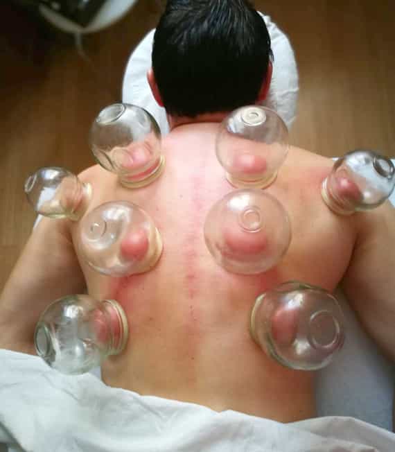 Tuina Anmo schroepfen-ruecken