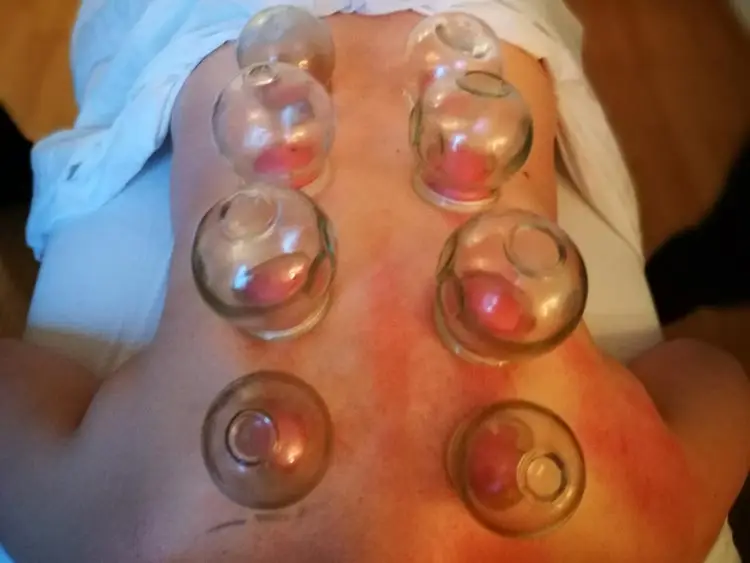 tuina-workshop-massage-schroepfen-1